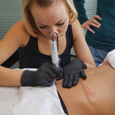 skin needling zabieg