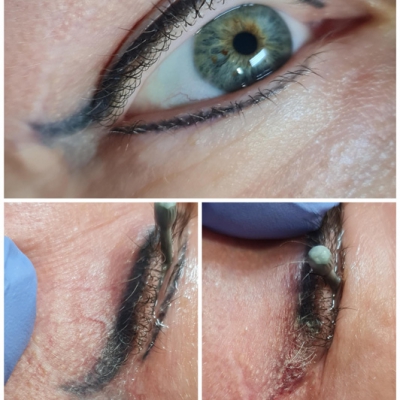 laserowe usuwanie makijażu permanentnego kresek efekty