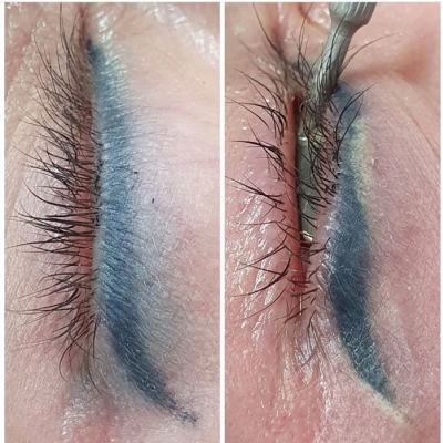 Laserowe usuwanie makijażu permanentnego kresek na powiekach