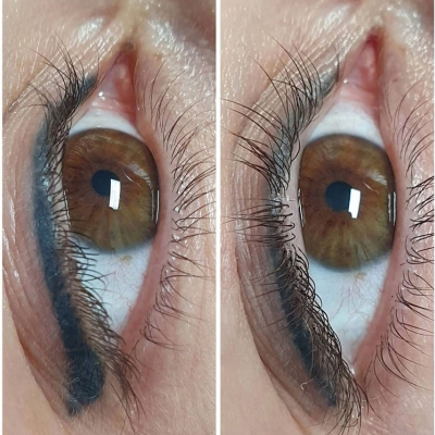 laserowe usuwanie makijażu permanentnego kresek przed i po