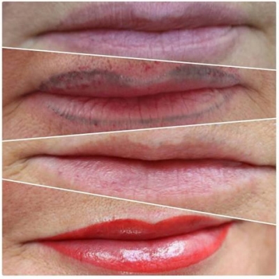 Laserowe usuwanie makijażu permanentnego usta. Efekt przed i po