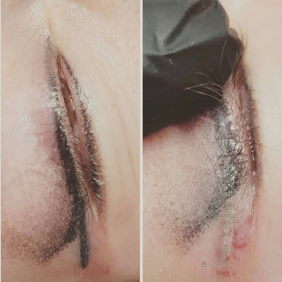 Usuwanie czarnej rozlanej kreski, makijaż permanentny