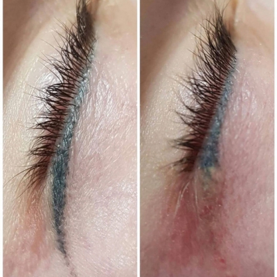 Laserowe usuwanie niebieskiej kreski makijaż