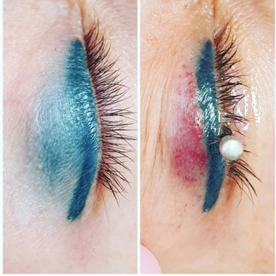 Laserowe usuwanie niebieskiej kreski makijaż